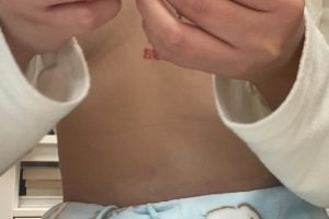 乳钉yin chun钉上钉手术实拍